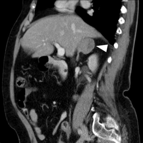 c: Abdominal CT scan revealing the mass of the right adrenal gland ...