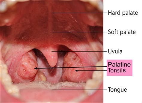 Peritonsillar abscess causes, signs, symptoms, diagnosis and treatment