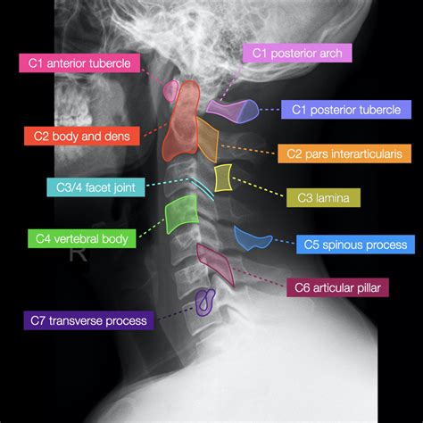 Normal Radiographic Anatomy Of The Cervical Spine Anatomy Medica ...