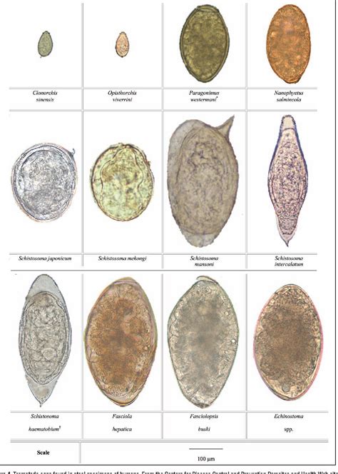 Figure 4 from Fascioliasis Due to Fasciola hepatica and Fasciola ...