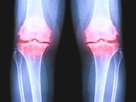 X-Ray for Osteoarthritis of the Knee