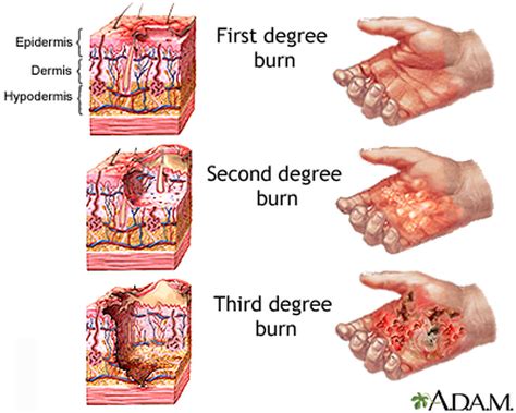 How Do You Look After A Burn at Rick Zoll blog