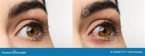 Collage with Photos of Woman with Inflamed and Healthy Eyes before and ...