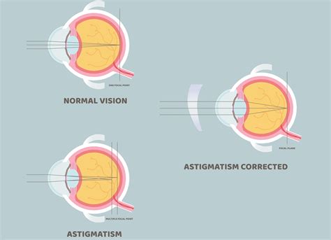 Astigmatism: Symptoms, Causes & Treatment | Kraff Eye Institute