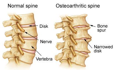 Treatment of Arthritis in the Neck in NJ | Pain Management Doctor