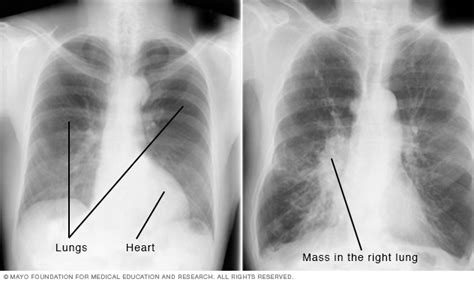 Chest X-rays | Beacon Health System