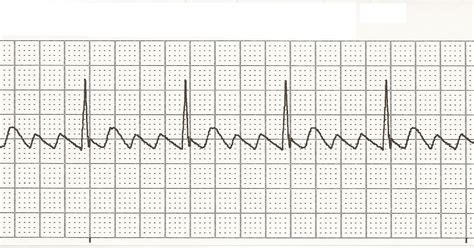 Float Nurse: EKG Rhythm Strips 27: Atrial Rhythms