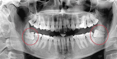 wisdom teeth recovery guide