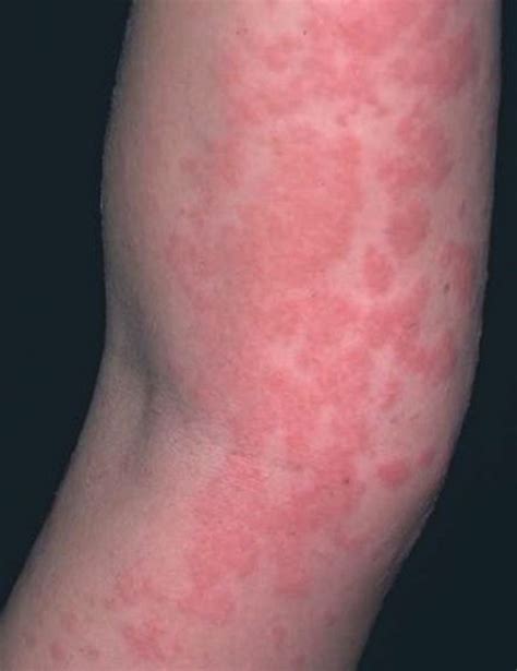 Tomato Allergy Rash Pictures