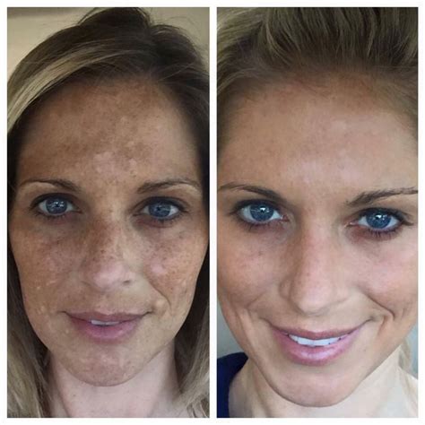 Check out Jenna McPeek's results using the Reverse regimen to treat ...