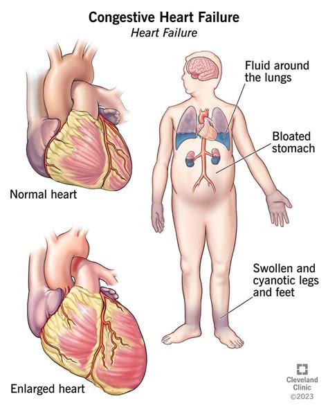 Congestive Heart Failure: Symptoms, Stages & Treatment