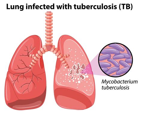 Tuberculosis (TB) Guide | Aurora Health Care