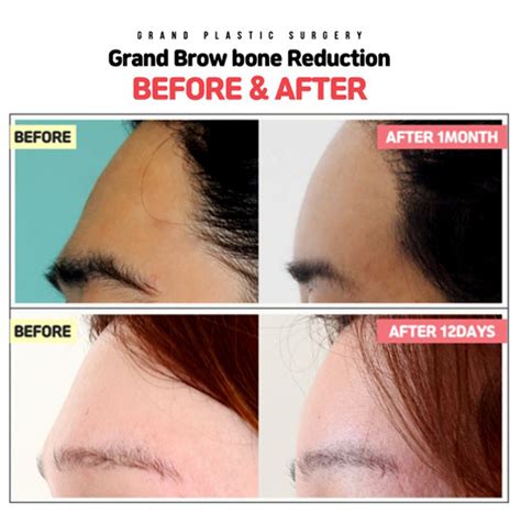 Brow bone reduction