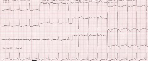 Left ventricular hypertrophy (LVH) with strain pattern – All About ...