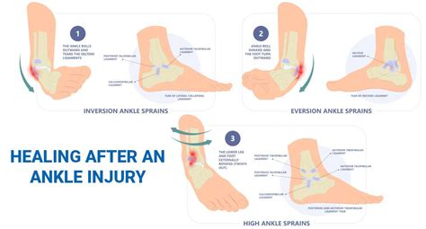 How to Heal a Ankle Injury using Sprain Ankle Treatment