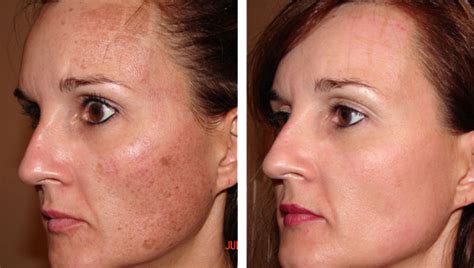 Enlarged Pores Treatment Minneapolis -- Skin Rejuvenation Clinic