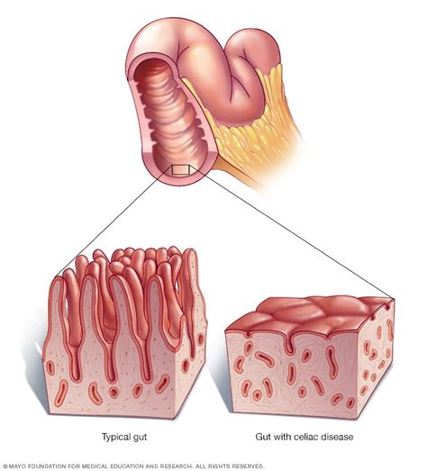 Celiaquía - Síntomas y causas - Mayo Clinic