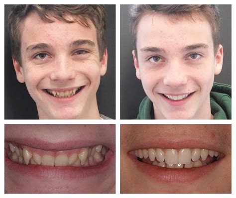 Teeth Whitening Before And After - Houston, TX Patch