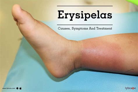 Erysipelas - Causes, Symptoms And Treatment - By Dr. Vinod Chavan | Lybrate