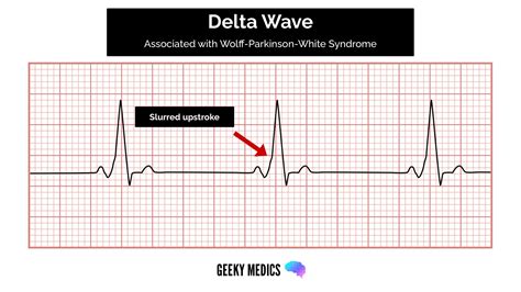 How to read an ECG | ECG Interpretation | Geeky Medics