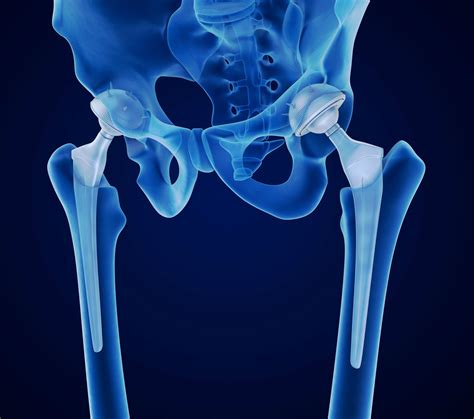 Patients Claim Manufacturer Responsible for DePuy Hip Implant Failure ...