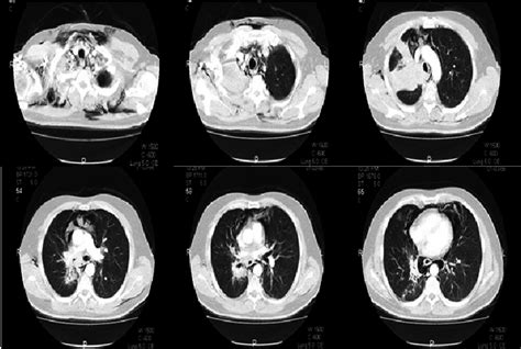 Thorax CT images of the patient on admission. | Download Scientific Diagram