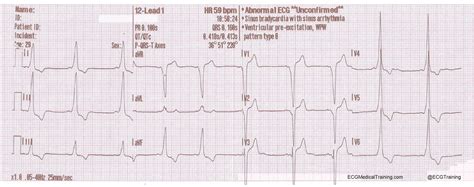 Wolff-Parkinson-White Syndrome - Part 1 - ECG Medical Training