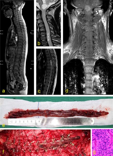 A 30-year man diagnosed with intramedullary spinal cord tumors. MRI ...