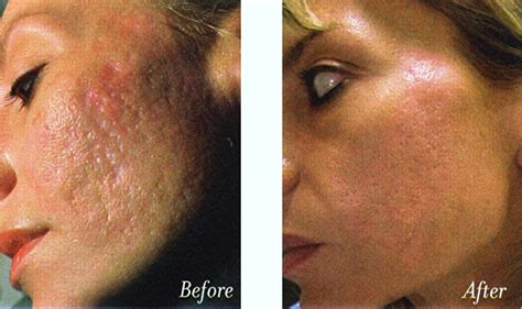 best treatment for acne scars and large pores: acne scars treatment ...