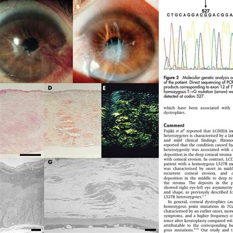 (A) Right eye showing diffuse injection of the inferior sclera. (B ...