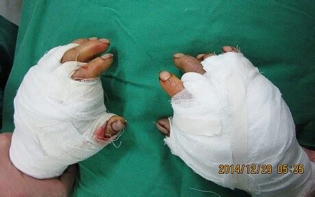 Surgeons reattach factory worker’s severed fingers in marathon operation