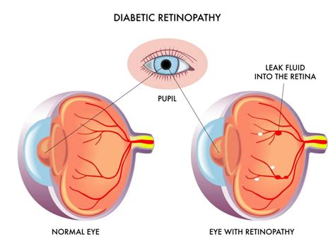 Diabetic Retinopathy Laser Surgery | Boca Raton & Coral Springs