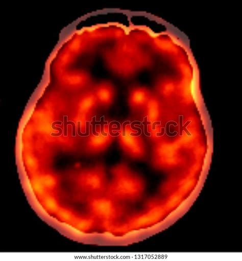 Pet Ct Scan Human Brain Axial Stock Photo (Edit Now) 1317052889