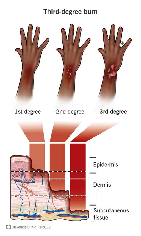 3rd-Degree Burn: What It Is, Treatment & Healing