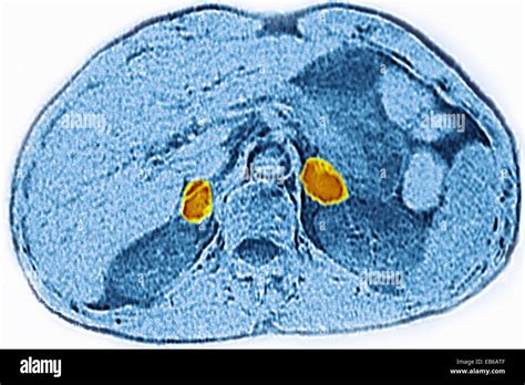 ADRENAL GLAND, CT SCAN Stock Photo - Alamy