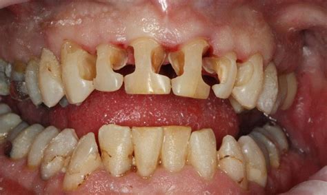 Anterior White Fillings Before & After Photos | Lead SD