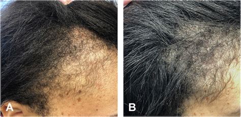 Minoxidil Before And After: Photos & Results | Wimpole Clinic