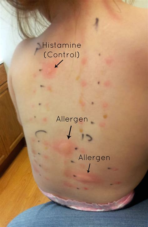 Skin Allergy Test | Nutrition Mission