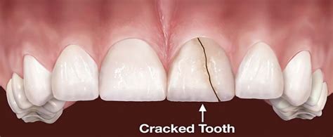 Cracked Tooth Repair - Broken Tooth Repair in Royal Palm Beach ...