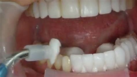 5 Things Everyone Should Know Before Getting Dental Veneers | Veneers Dubai