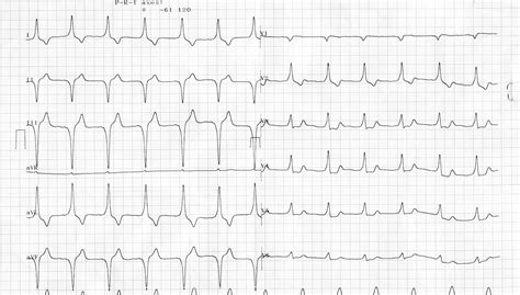 WPW Syndrome - How to Read ECG