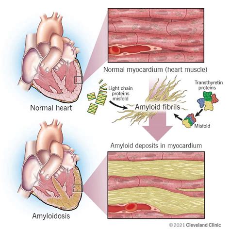 Cardiac Amyloidosis: Causes, Symptoms and Treatment | Flipboard