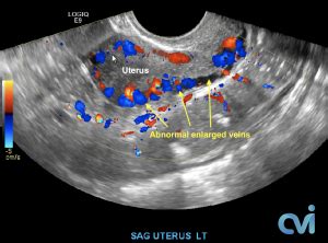 Pelvic Congestion Syndrome - Pelvic Pain Embolization Treatment