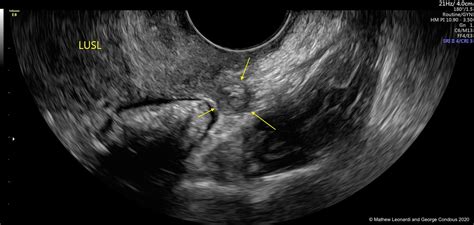 Noninvasive ultrasound diagnosis of endometriosis | Contemporary OB/GYN