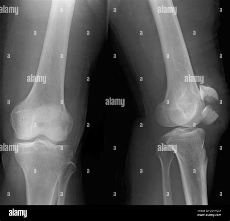 Human knee cap Black and White Stock Photos & Images - Alamy