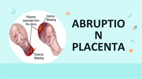 SOLUTION: ABRUPTION PLACENTA CASE STUDY - Studypool