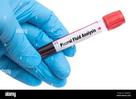 Pleural fluid analysis, conceptual image Stock Photo - Alamy