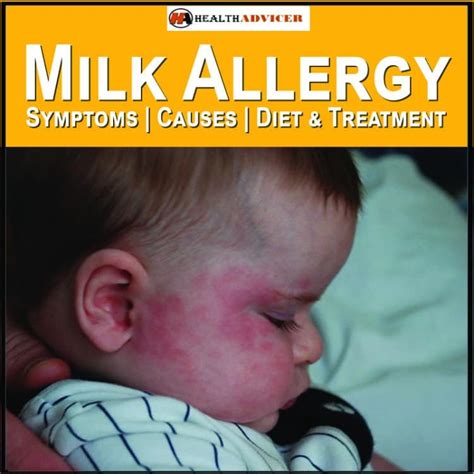 Milk Allergy: Symptoms, Causes, Diet, And Treatment