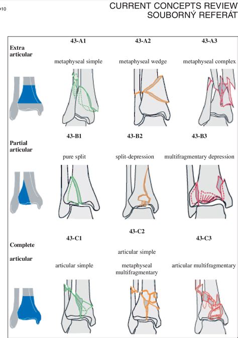 Tibial Plafond