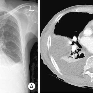 Photographs of the pleural biopsy specimen. Thoracoscopic pleural ...